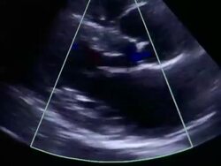 ECU Echocardiogram ultrasound of heart beating on computer / Vermont, USA Stock Footage