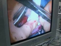 CU Monitor showing doctors doing childs heart surgery / Little Rock, Arkansas, USA Stock Footage