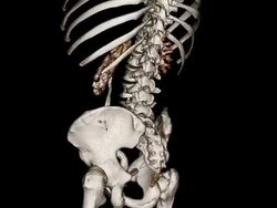 CT pyelogram Stock Footage