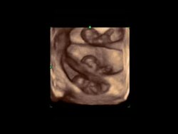 Triplet foetuses in womb, 4D ultrasound scan.. Stock Footage