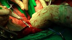 surgery operation Stock Footage