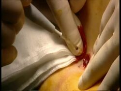 CU Surgeon's hands cauterising wound Stock Footage