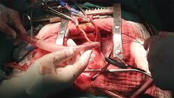 Accident Air locking in open heart surgery Stock Footage