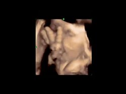 Close up on Foetus sucking thumb, 4D ultrasound scan.. Stock Footage
