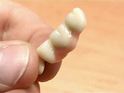 dental implants Stock Footage