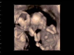 Twin foetuses moving in the womb, 4D ultrasound scan.. Stock Footage