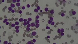 Myeloblast in Leukemia disease under microscope Stock Footage