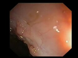 Colon polyps. Endoscope view of the colon (large intestine) showing inflammatory polyps in a patient with ulcerative colitis.. Stock Footage