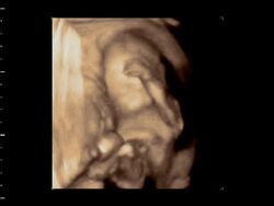 Foetus rubbing head with left hand, 4D ultrasound.. Stock Footage