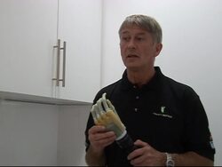 Bionic hands change the lives of amputees News Clip