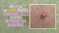 What's the Deal with Warts? Instructional Video