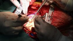 Heart surgeon suture LIMA to LAD anastomosis Stock Footage