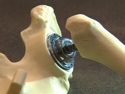 Artificial Hip For Replacement Surgery Stock Footage
