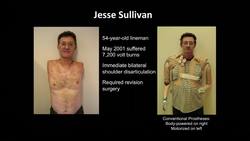 Todd Kuiken: A prosthetic arm that "feels" Instructional Video