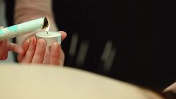 Heating of acupuncture needles with the smoke Stock Footage