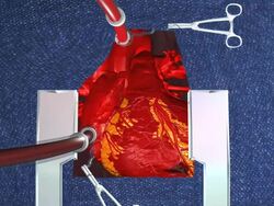 Coronary artery bypass surgery, also coronary artery bypass graft surgery, and colloquially heart bypass or bypass surgery is a surgical procedure performed to relieve angina and reduce the risk of death from coronary artery disease Stock Footage