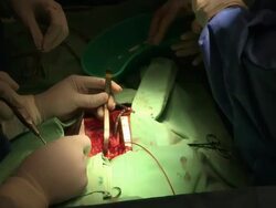 open-heart sergery, doctors around the operated child, in wolfson hospital. Save A Child''s Heart project. Stock Footage