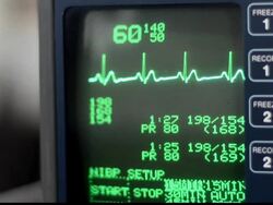 ECG monitor Stock Footage