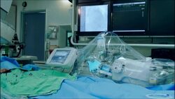 Vascular surgery. Ballon angioplasty Stock Footage