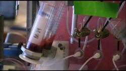 Efforts to develop blood test that can identify single cancer cells Instructional Video