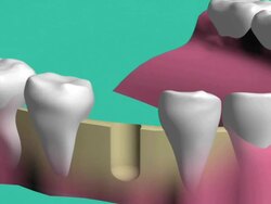 Technology installation of dental implants Stock Footage
