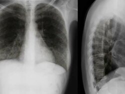 The lung disease X ray film. Stock Footage