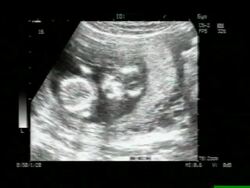 Twins, ultrasound scan. Stock Footage