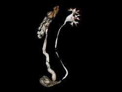 CT pyelogram Stock Footage