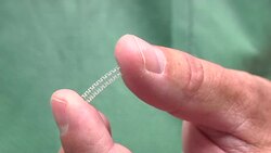 Arizona Man Among First to Get Dissolvable Stent News Clip