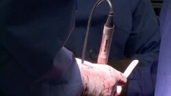 CLEAN : Indian surgeons reconstruct babys News Clip