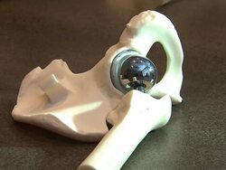 Artificial Hip For Replacement Surgery Stock Footage