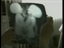 Conjoined twins born in Armenia, only one survives News Clip