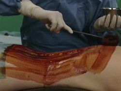 MS PAN Nurse preparing and spreading disinfectant tincture / Cagliari, Sardinia, Italy Stock Footage