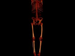 Multiâ€“Detector CT Angiography of Lower Extremity Stock Footage