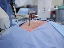 Surgery, surgeon, surgical, health care, medicine, medical, hospital, doctor. Stock Footage