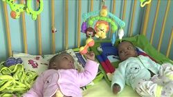 CLEAN : Madagascar health minister separates siamese twins News Clip
