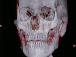 CU CT scan of human skull / Vermont, USA Stock Footage