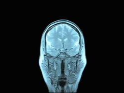 MRI Scan Of Human Brain (Blue Toned) Stock Footage