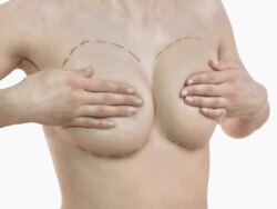HD DOLLY: Breast Augmentation Stock Footage
