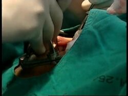 THAILAND: CLEFT LIP OPERATIONS HELP THAI KIDS News Clip