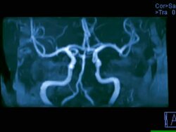 Circle of Willis. Coloured rotating magnetic resonance angiography (MRA) scan of blood vessels in the circle of Willis (centre) in the brain. This network of arteries at the base of the brain supply the organ with oxygenated blood. Stock Footage