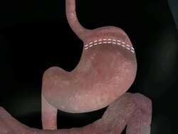 Gastric bypass procedures (GBP) are any of a group of similar operations used to treat morbid obesity the severe accumulation of excess weight as fatty tissue and the health problems (comorbidities) it causes. Stock Footage