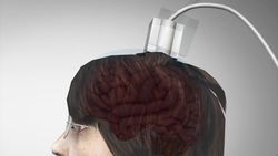 Braingate patient uses thought to control robotic arm Instructional Video