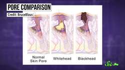 Are Those Really Blackheads? Instructional Video