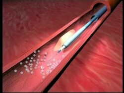 Pioneering stem cell treatment offered in Bangkok News Clip