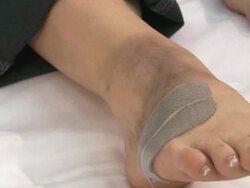 Close up of injured womans leg Stock Footage