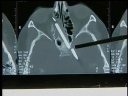 A woman in Germany has had a pencil removed from her head after more than 50 years. News Clip