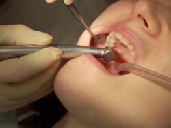Dentist and assistant making dental filling Stock Footage