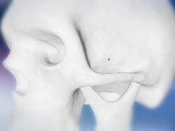 HD: Human Skull Indicating Otitis Stock Footage