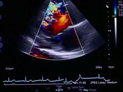 CU Echocardiogram ultrasound of heart beating on computer / Vermont, USA Stock Footage